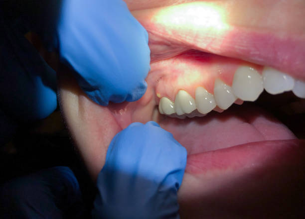 Best Root Canal Emergency Dentist  in Bazon, CA